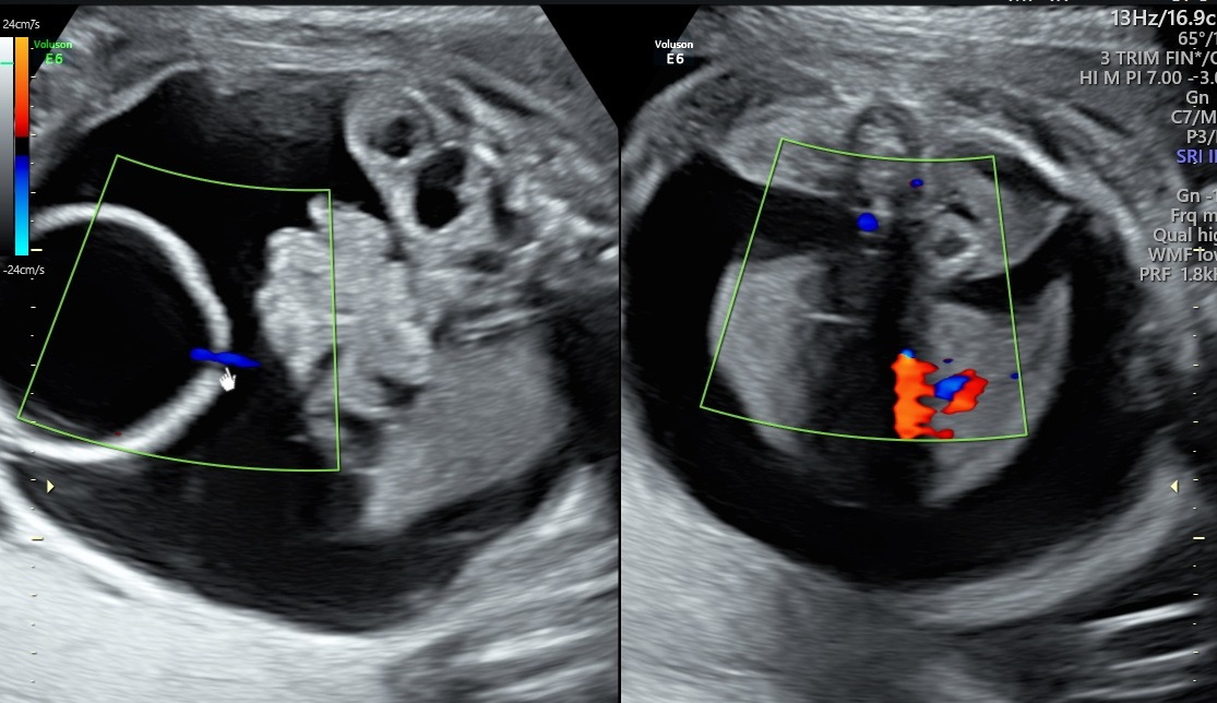 A very rare fetal complication due to obstructive uropathy ScholarMD
