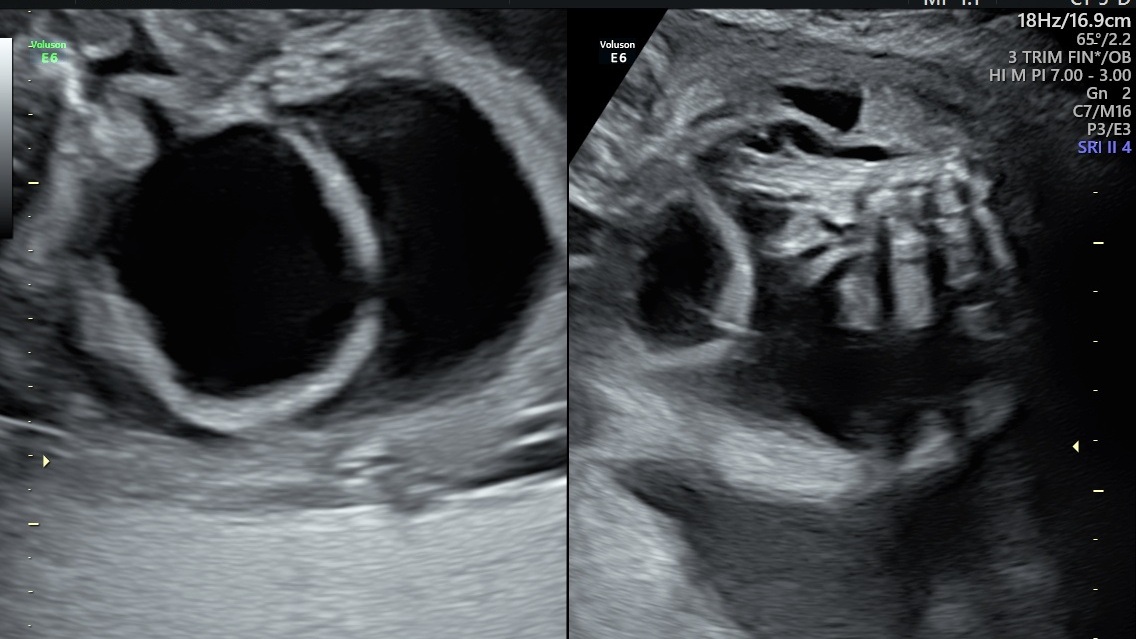 A very rare fetal complication due to obstructive uropathy ScholarMD