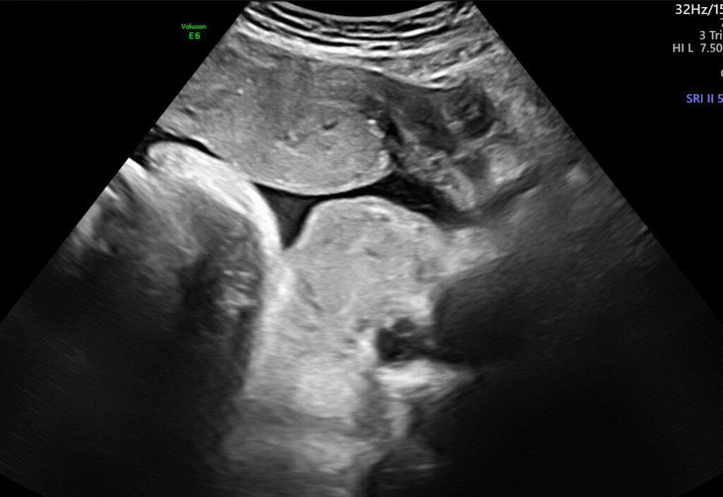 Fetal Facial Mass On Ultrasound ScholarMD