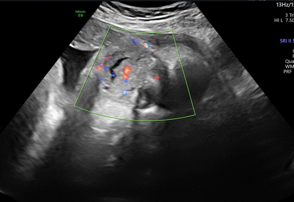 Fetal Facial Mass On Ultrasound ScholarMD