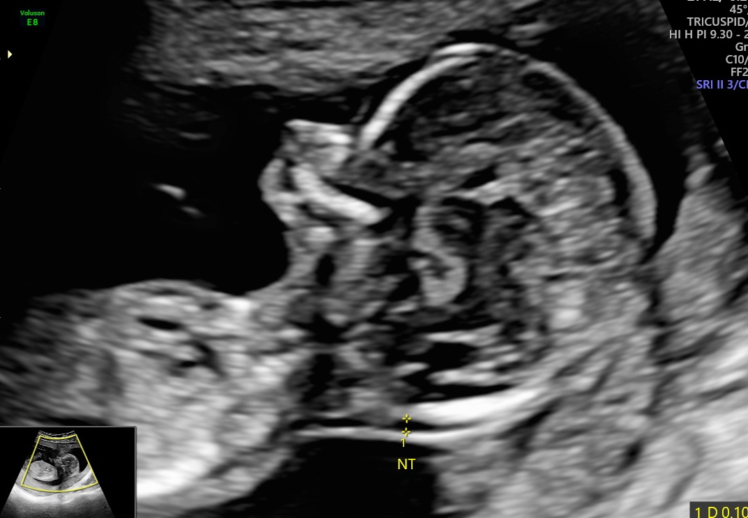 Turners Syndrome Ultrasound